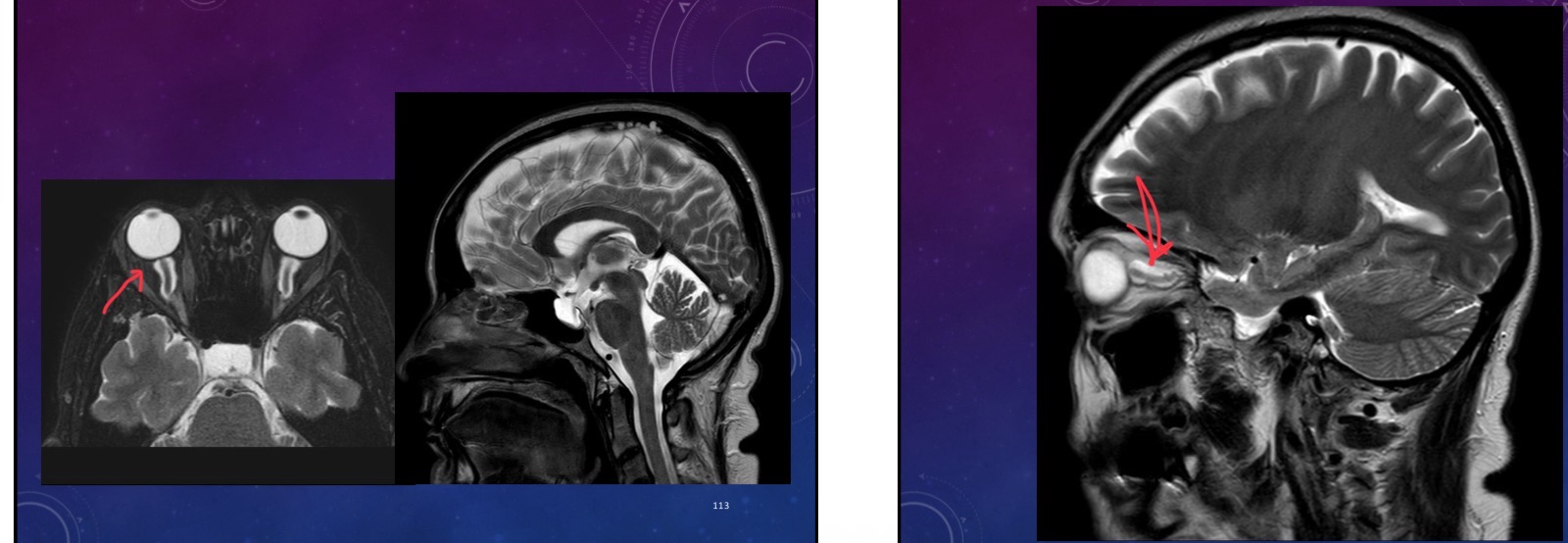 <p>35-year-old female presents with a chronic headache and upper and lower limb numbness</p>