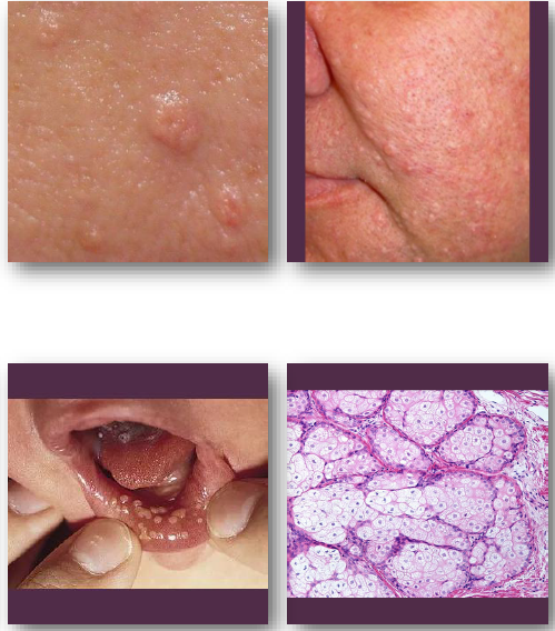 <p>• <strong>Small, soft papules with central depression</strong></p><p>• <strong>White, yellow, or normal skin color</strong></p><ul><li><p>Often shows <strong>central umbilication</strong></p></li></ul><p>•Common on <strong>nose, cheeks, and forehead (oil glands!)</strong></p><p>•Sebum may be expressed with pressure</p>