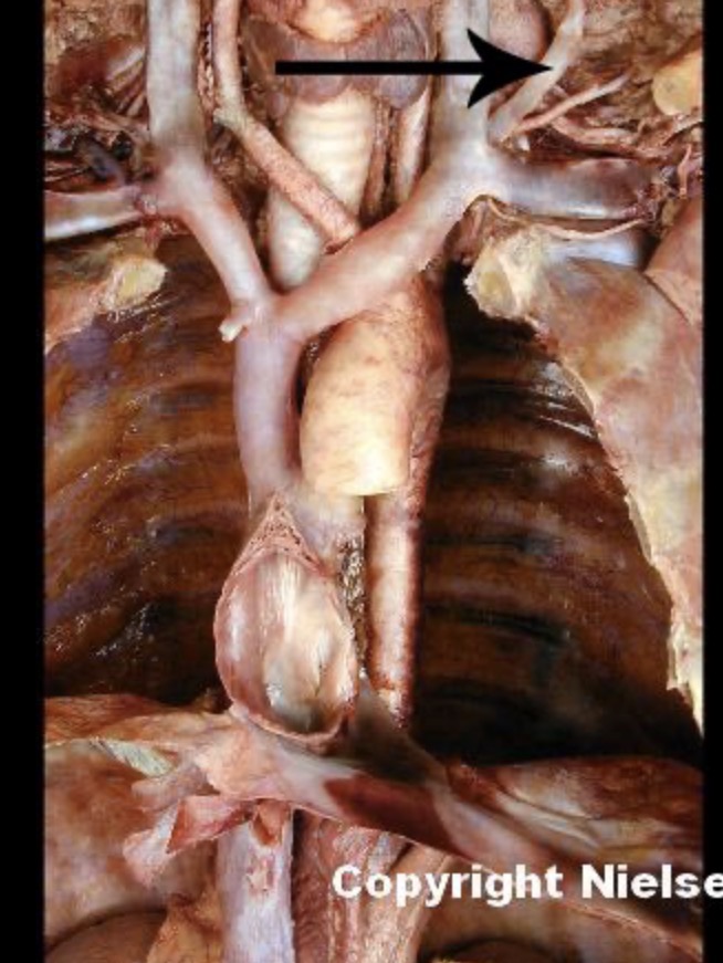 <p>The indicated vessel is the _. The indicated vessel primarily drain the superficial regions of the _ and _</p>