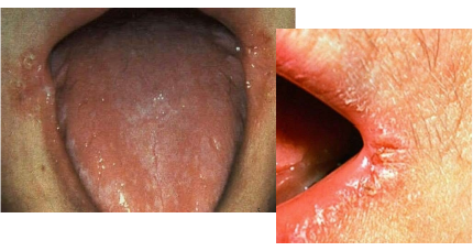 <p>How is angular cheilitis treated?</p>