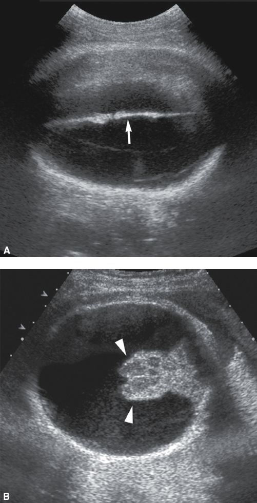 <p>Fluid-filled cranium</p><p>Absent or partial absence of the falx cerebri</p><p>Maintained brainstem, basal ganglia, and, perhaps, the thalamus</p><p>No identifiable cerebral cortex</p>