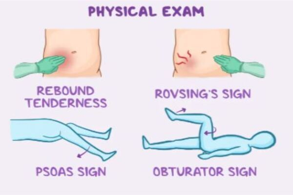 <ol><li><p><span style="color: rgb(241, 84, 84);"><strong>McBurneys </strong></span><span style="color: rgb(8, 5, 5);">point tenderness</span><span style="color: rgb(241, 84, 84);">: RLQ pain </span><span style="color: rgb(23, 10, 10);">when pressing down</span></p></li><li><p><span style="color: rgb(79, 83, 193);"><strong>rovsings </strong></span>sign: pain in <span style="color: rgb(46, 81, 221);">RLQ when left side</span> is pressed</p></li><li><p><span style="color: rgb(33, 176, 141);"><strong>psoas </strong></span>sign: pain in <span style="color: rgb(59, 171, 153);">right abdomen when right leg lifted</span></p></li><li><p><span style="color: rgb(215, 31, 235);"><strong>obturator </strong></span>sign: pain when <span style="color: rgb(243, 50, 231);">hip and knee are bent and the <strong>leg is rotated</strong> inward</span></p></li></ol><p></p>