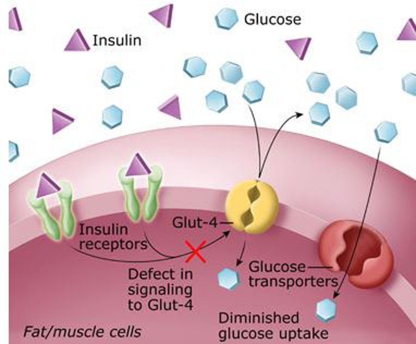 <p>-problem is insulin resistance, pancreas is pumping out so much insulin to make up for tons of glucose and cells are super tired of seeing insulin, cells become insulin resistant</p><p>-RF: lifestyle related, obesity, age, HTN (blood moving to quickly, epithelial injury damage - glucose damaging to body because all of the complications that come from diabetes are from how damaging this molecule is, as glucose is rocketing through a blood vessel at a fast rate and it stabs the side of a blood vessel and causes damage and can start atherosclerosis, also has issues getting through kidneys and tiny arteries</p><p>-decreased insulin secretion: diabetes is a progressive problem - can move forwards or backwards</p><p>-Tx: strict diet or oral medication: glycerides, metformin (helps pancreas to produce more insulin or on cells themselves to be become more receptive - can still move backwards and cure yourself of diabetes)</p><p>-once you become insulin dependent and cant go backwards and need insulin for life, pancreas has quit and pancreas does not work anymore so resembles type 1.</p><p>Sx: 3 p's decreased energy, obese, recurrent infections (bacteria loves sugar), FBS is greater than 125 mg/dl</p>