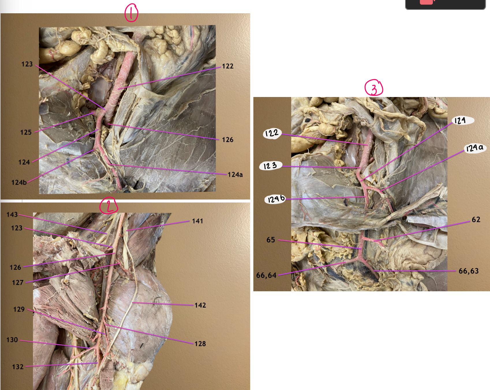 <p>medial view of blood flow near inguinal canal</p><p>pic 2 follows 126</p><p>pic 3 follows 123</p><p>.</p><p>label 122-124, 124a, 124b</p>