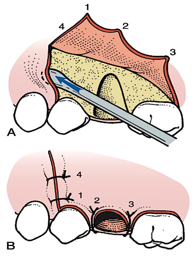 <p>vertical end of the incision must be closed separately with <span style="color: red;">2 sutures for the vertical end</span></p><p><span style="color: rgb(255, 0, 0);">#9 periosteal elevator </span>ā to elevate the non-flap side of the incision, <span style="color: red;">facilitate passage of the needle</span></p><p>when it is repositioned, the <span style="color: red;">first suture</span> is placed at the<span style="color: red;"> occlusal</span> end of the vertical-releasing incision (1). the<span style="color: red;"> papillae</span> are then sutured sequentially (2, 3), and finally, the <span style="color: red;">superior aspect </span>of the releasing incision is sutured (4)</p>