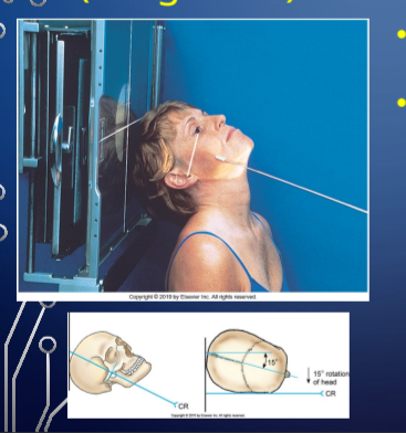 <p>pat pos of OBL INFSUP (TANGENTIAL) — <strong>ZYGO ARCHES</strong></p>
