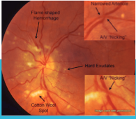 <p>-Hypertensive retinopathy is retinal vascular damage caused by hypertension. Signs usually develop late in the disease. Funduscopic examination shows arteriolar constriction, arteriovenous nicking, vascular wall changes, flame-shaped hemorrhages, cotton-wool spots, yellow hard exudates, and optic disc edema</p><p>-Sx- double vision, headaches, reduced vision, blood vessel bursting</p><p>-Tx- regular BP checks and control HBP</p>