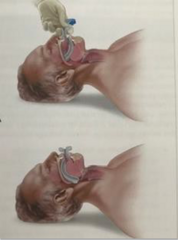 <p>-supplemental O2</p><p>-insertion or nasal or oropharyngeal airway</p><p>-definitive airway</p><p>-mechanical ventilation</p><p>-management of chest trauma</p>