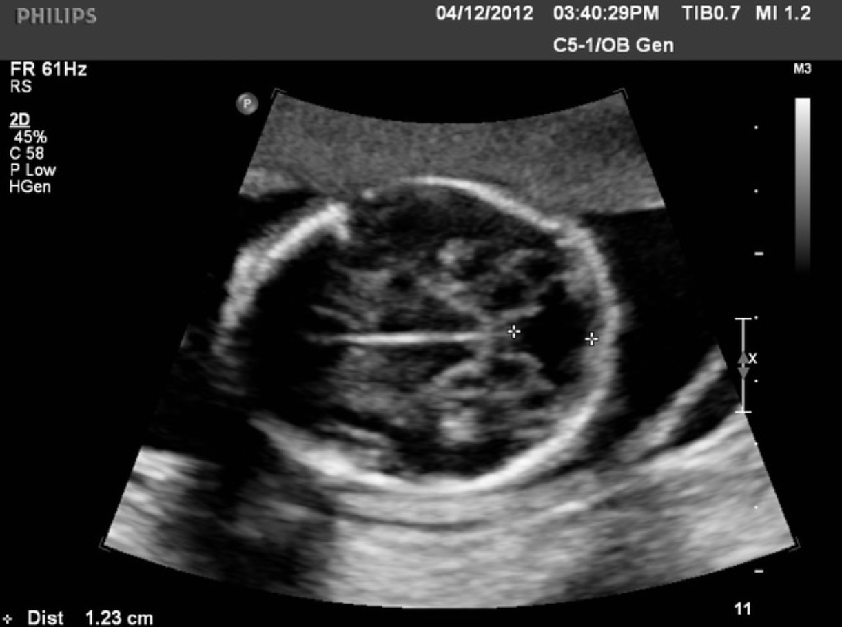 <p>What pathology is seen in this image?</p>
