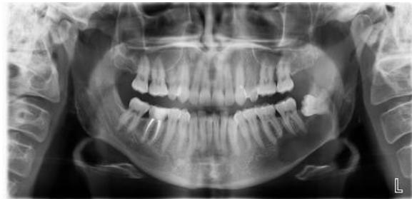 <p>A 19 year old patient present with mild swelling of lower jaw. Intra orally a small swelling was visible over left third molar region. A radiograph taken. Provide Differential diagnosis</p>