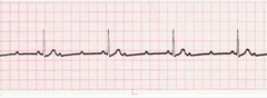<p>PR interval is constant...QRS is missing</p><p>"2 small p waves right after each other"</p><p>give atropine, dopamine, or epi to increase HR is symptomatic bradycardic</p>