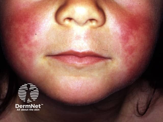 <p>Scarlet fever</p>