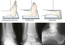 <p>flexed somewhat</p><p>15-20 degrees internally rotated or until intermalleolar line appears parallel to IR</p><p>lengthwise</p><p>1-2inch above lateral malleolus </p>