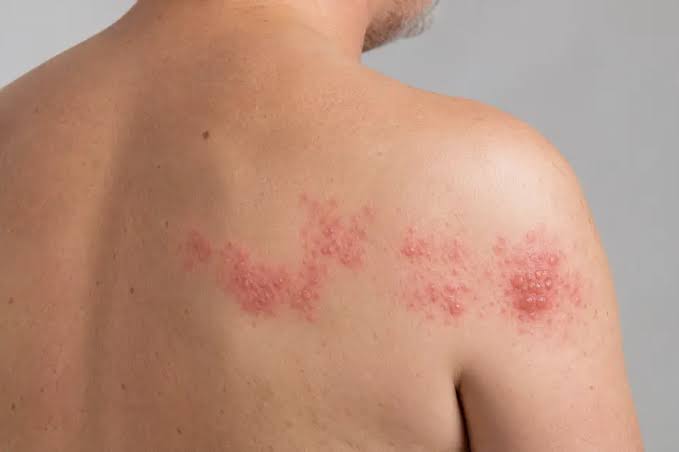 <p>Shingles</p>