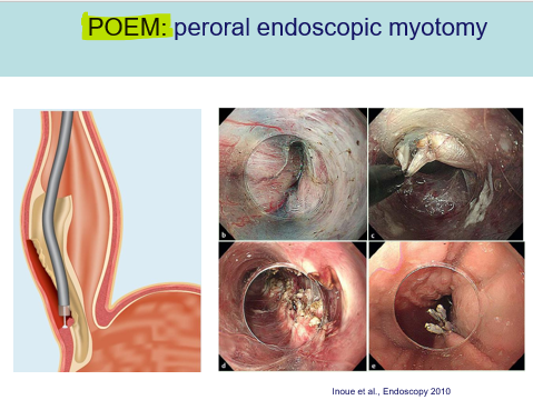 <p>peroral endoscopic myotomy</p><p></p><p><span>Meest recente behandeling.</span></p><p style="text-align: left;"></p><p style="text-align: left;"><span>Niet via de buik en door diafragma, maar via mond.</span></p><p style="text-align: left;"></p><p style="text-align: left;"><span>Tunnel maken onder submucosa en dan de spier doornemen en terug sluiten.</span></p>