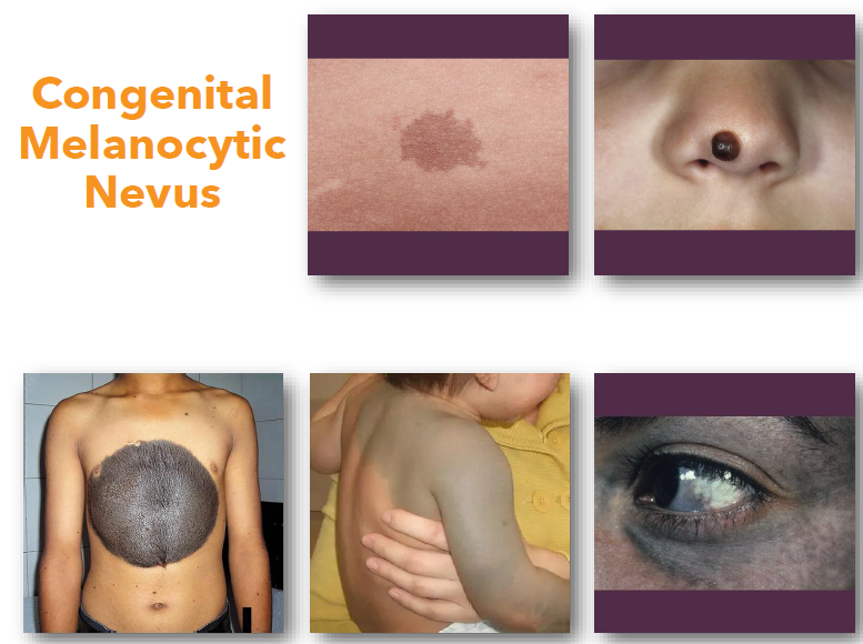 <p>melanocytic nevi </p>