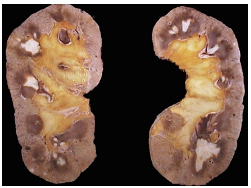 <p>A 55-year-old male with chronic NSAID use develops chronic kidney disease. The attached image shows a gross depiction of his renal pathology. Which of the following mechanisms best explains this NSAID-associated injury?</p>