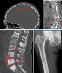 <p>What is this?</p><p>- 50-70 yo, Black male</p><p>- Pain</p><p>- Skull, Spine, Humerus, Femur</p>