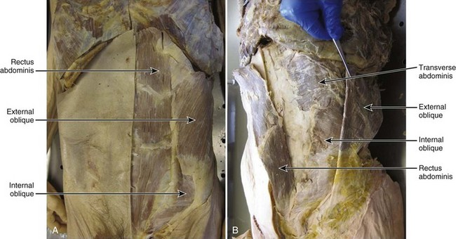 <p>External Abdominal Oblique Muscle</p><p>Origin: Ribs 5-12</p><p>Insertion: Via aponeurosis to linea alba, pubic crest, iliac crest</p><p>Innervation: Ventral rami of lower 6 thoracic spinal nerves, iliohypogastric nerve and ilioinguinal nerve</p><p>Function: Support and compress abdominal contents, assist flexion and rotation of trunk</p>