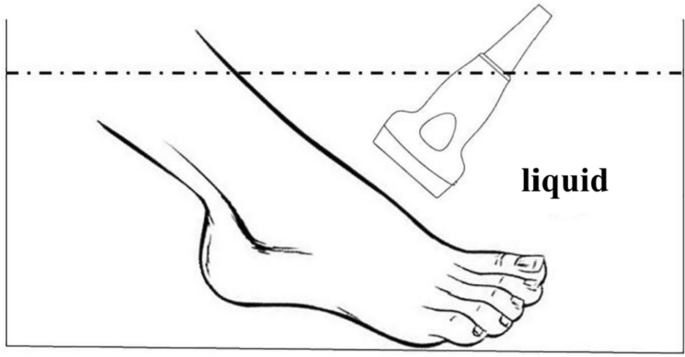 <p>When water is used as a coupling agent instead of gel typically for uneven surfaces (ex. hands/fingers or feet)</p><ul><li><p>The involved body part &amp; sound head of the US device are submerged in a plastic container of water</p></li><li><p>The sound head is held 1-2 cm away from the body part</p></li><li><p>Intensity must be increased by 50% (0.5) compared to direct </p></li></ul><p></p>