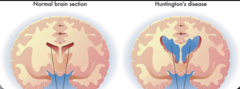 <p>Initial presentation between age 30-40</p><p>- Degeneration in basal ganglia</p><p>- Chorea: Involuntary movements</p><p>- Dementia</p><p>- Death typically 10-20 yrs after dx</p>