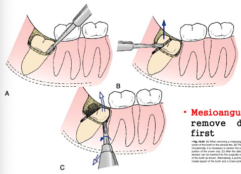 <p>easiest</p><p>remove <span style="color: red;">distal half of crown at buccal groove</span> just below cervical line</p><p>elevate remainder with a no. <span style="color: red;">301 elevator </span>or <span style="color: red;">crane pick</span></p>