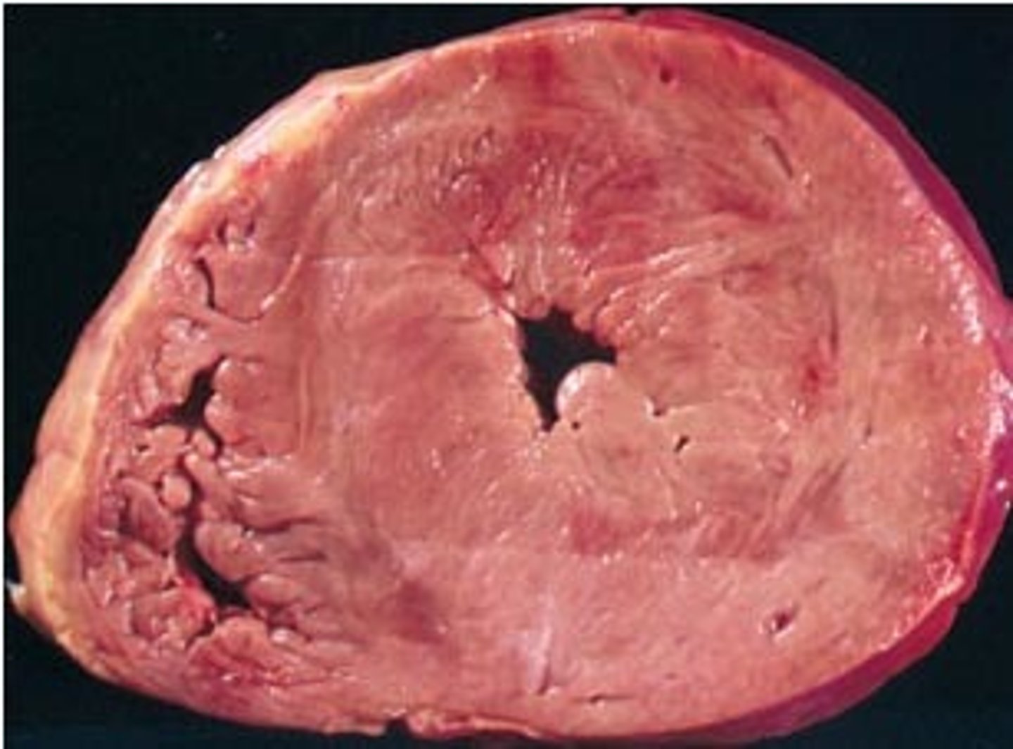 <p>Increase cell size</p><p>-enlarged tissue mass</p><p>-increased workload</p>