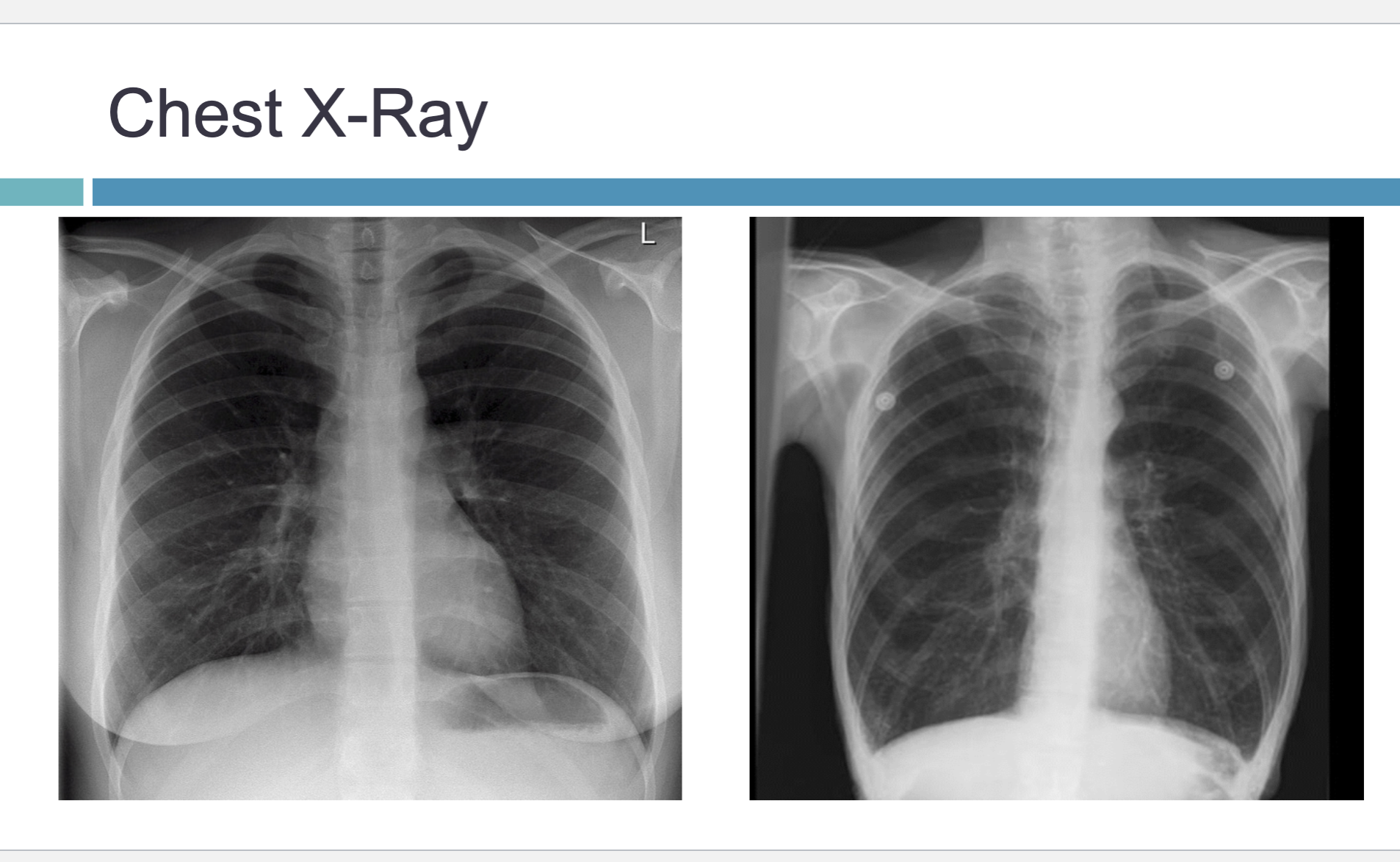 <p>Look for sharp costophrenic angles</p><p> Blunting</p><p> pleural effusion if fluid</p><p> May be able to see a water line</p><p> Flattened diaphragms</p><p> Possible COPD if approximately 90 degrees</p><p> Look at cardiophrenic angles as well</p><p> Left hemi-diaphragm is usually lower than the right</p><p> Why? The liver pushes up the right hemidiaphragm</p>