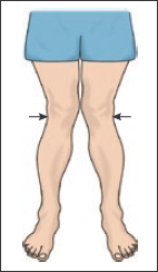 <p>The knees are in close position and the space between the ankles is increased, referred to as “knock-kneed”</p>