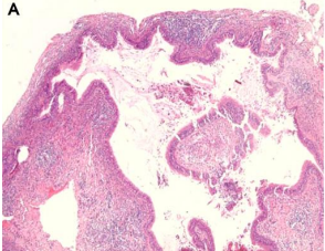 <p>A 42-year-old woman came complaining of intermittent stinging pain in her right cheek. There were no clinically abnormal findings in physical and oral examinations. Radiograph showed a cystic swelling in maxillary antrum. The patient only had a history of orthognathic surgery on both the maxilla and the mandible performed about 21 years prior to this visit</p>