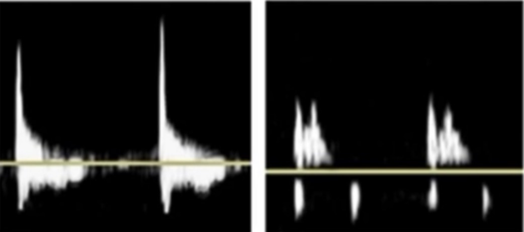 <p>A very high resistive pattern with a short “spike” of velocity acceleration and deceleration with low amplitude diastolic flow</p>