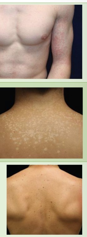<p>Macule: flat area of color change <1cm</p><p>EX: </p><ul><li><p>morbilliform drug reactions: erythematous, confluent round cacules</p></li><li><p>tinea versicolor: mult. hypopigmented or hyperpigmented or tan macule</p></li><li><p>benign melanocytic nevi: symmetrical pigmented, round/oval, brown macules</p></li></ul><p></p>