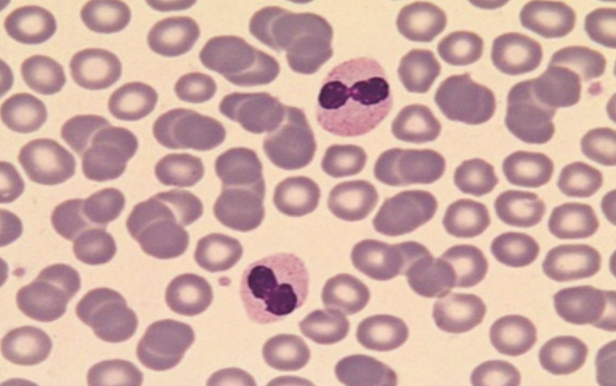 <p>what are the pelger-heut anomaly characteristics?</p>