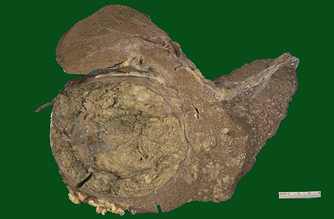 <p>large bulky greenish cast</p><p>smaller satellite nodules</p>