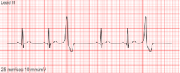 <p>If every third beat is a PVC,</p>