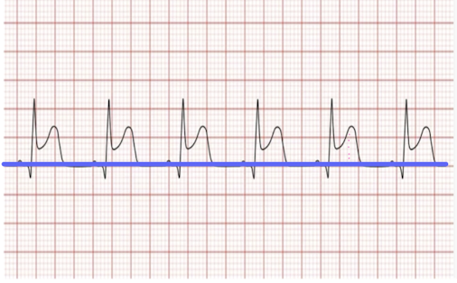 <p>A patient is walking on a treadmill with ECG leads attached. The PT observes the ECG as shown in the image below. What is the MOST LIKELY diagnosis and intervention? </p><p>a. myocardial ischemia that has an elevation of the ST segment greater than 1 mm and the PT should stop the protocol </p><p>b. myocardial infarction that has an elevation of the ST segment less than 1 mm and the PT should stop the protocol and call 911</p><p>c. myocardial ischemia that has an elevation of the ST segment less than 1 mm and the PT should stop the protocol </p><p>d. myocardial infarction that has an elevation of the ST segment greater than 1 mm and the PT should stop the protocol and call 911</p>
