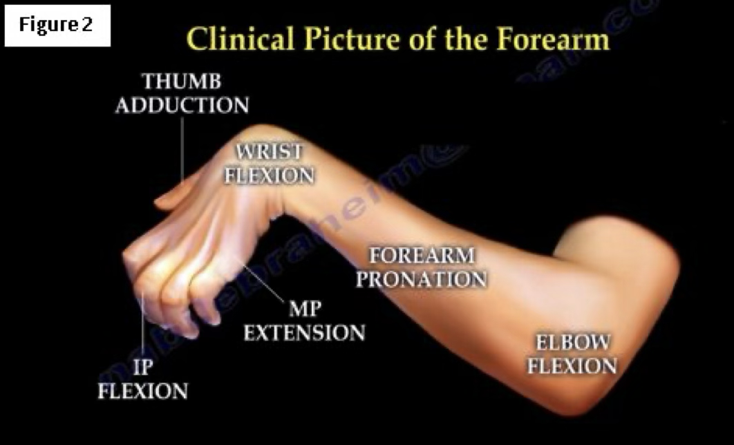 <p>volkmann’s contracture treatment</p>