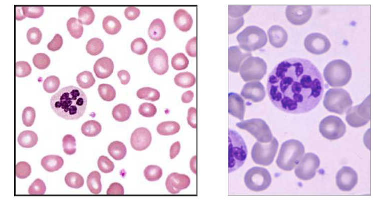 <p>Megaloblastic Anaemia</p>