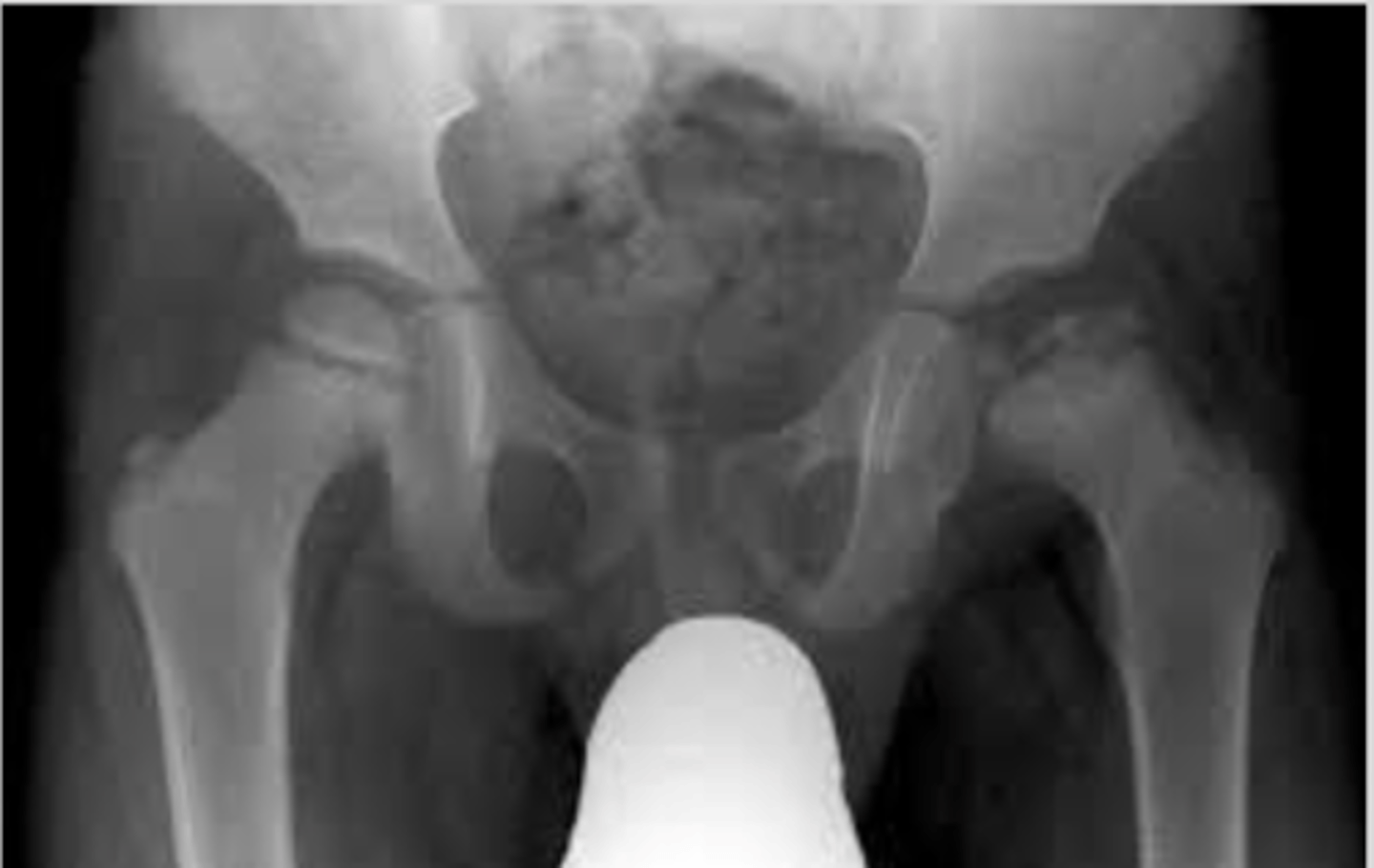 <p>Avascular necrosis of the femoral head</p>