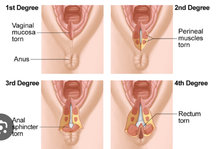<p> First degree: laceration that is confined to the <strong>skin</strong></p><p> Second degree: laceration that extends into the<strong> perineal body</strong></p><p> Third degree: laceration that involves injury to the <strong>external anal sphincter muscle</strong></p><p> Fourth degree: laceration that <strong>extends completely through the anal sphincter and the rectal mucosa</strong></p><p></p>