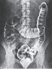 <p>Dual-contrast radiograph</p>