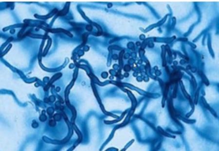 <p>Causes tinea versicolor</p><p>Spaghetti and meatballs morphology</p>