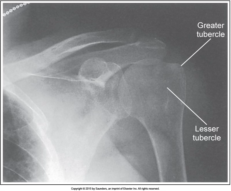 <p>AP external shoulder</p>