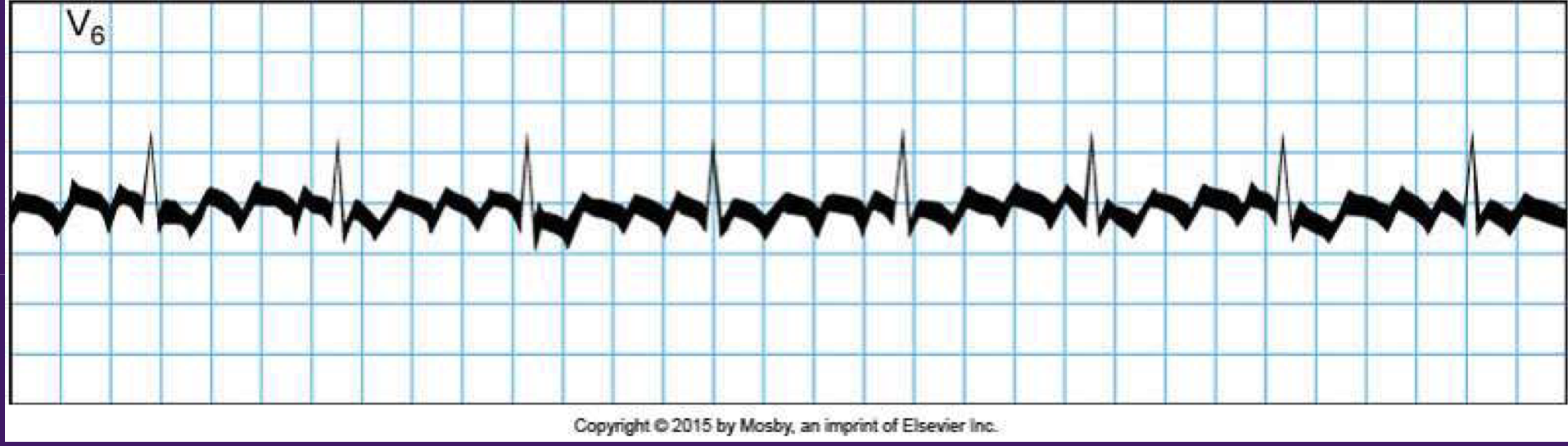 <p>Atrial (auricular flutter)</p>