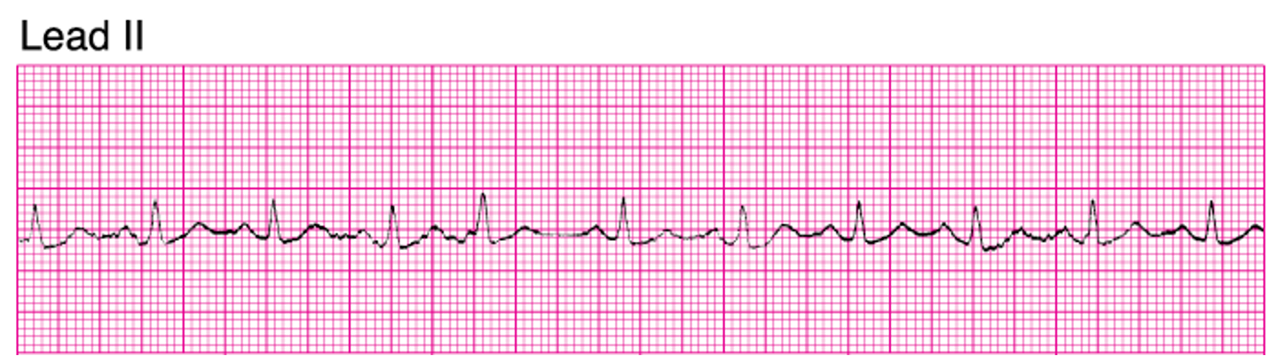 <p>What ECG is this</p>