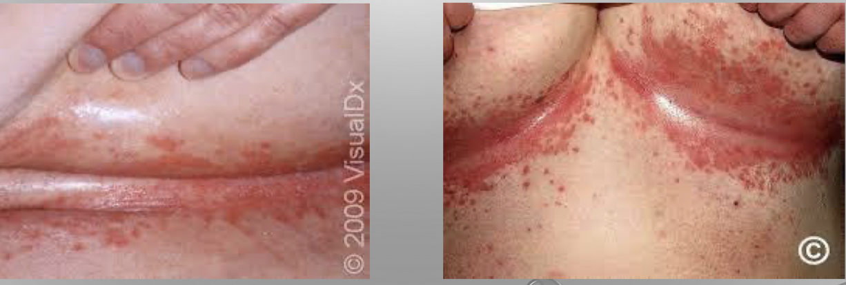 <p>fungal infection of the skin</p><p>cause: associated with candida albicans </p><p>symptoms: oral mucosaâ white, cheesy plaques on roof of mouth, tongue, can be irritating; skinâ diffuse, red rash, odor usually present</p><p>treatment: topicalâ Nystatin powder or ointment, keep skin clean, cool and dry; systemicâoral antifungal therapy, Fluconazole (Diflucan) </p>