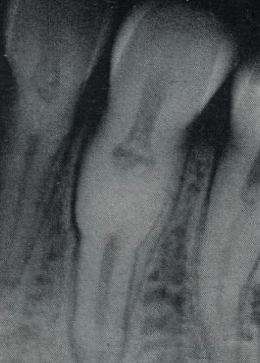 <p>have a normal color clinically, pulp chamber is enlarged = thistle tube or flame shaped, pulp stone, normal root </p>