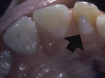 <p>accessory cusp of lingual incisor, usually, max lat incisor, 91% in max, usually has pulp tissue inside </p>