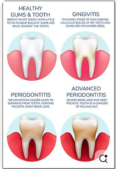 <p>name the tooth/gum disease that fits this description:</p><ul><li><p>immune cells attack intruders and body tissues</p><ul><li><p>destroy periodontal ligament</p></li><li><p>activate osteoclasts</p></li></ul></li><li><p>consequences</p><ul><li><p>possible tooth loss</p></li><li><p><em>promotion of atherosclerosis and clot formation in coronary and cerebral arteries</em></p></li></ul></li></ul><p></p>