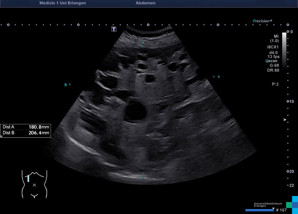 <p>Rare congenital condition characterized by segmental dilation of large, intrahepatic biles ducts. This appears are cysts on imaging</p>